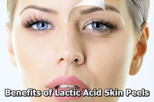 The Marvelous Benefits of Lactic Acid Skin Peels